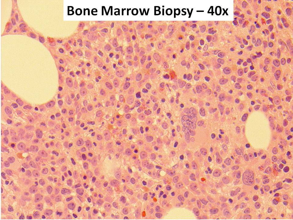 Bone marrow biopsy - 40x
